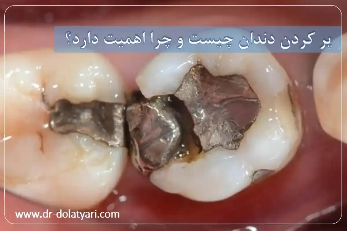 پر کردن دندان چیست و چرا اهمیت دارد؟