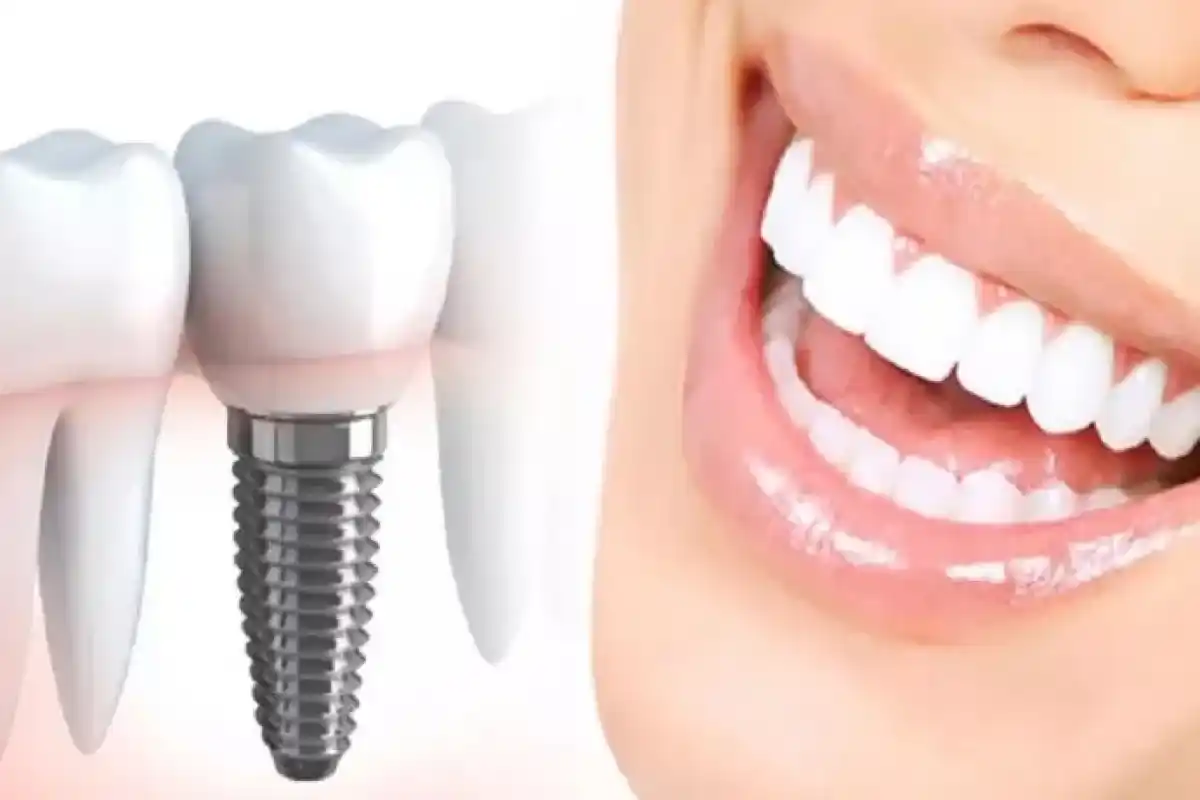 ایمپلنت با بیمه ایران در کرمانشاه