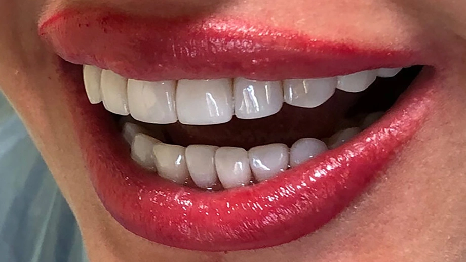 بهترین سن برای کامپوزیت 