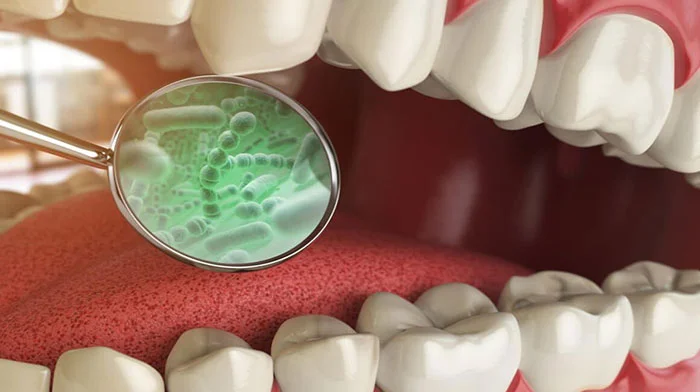 بوی بد دهان بعد از کامپوزیت