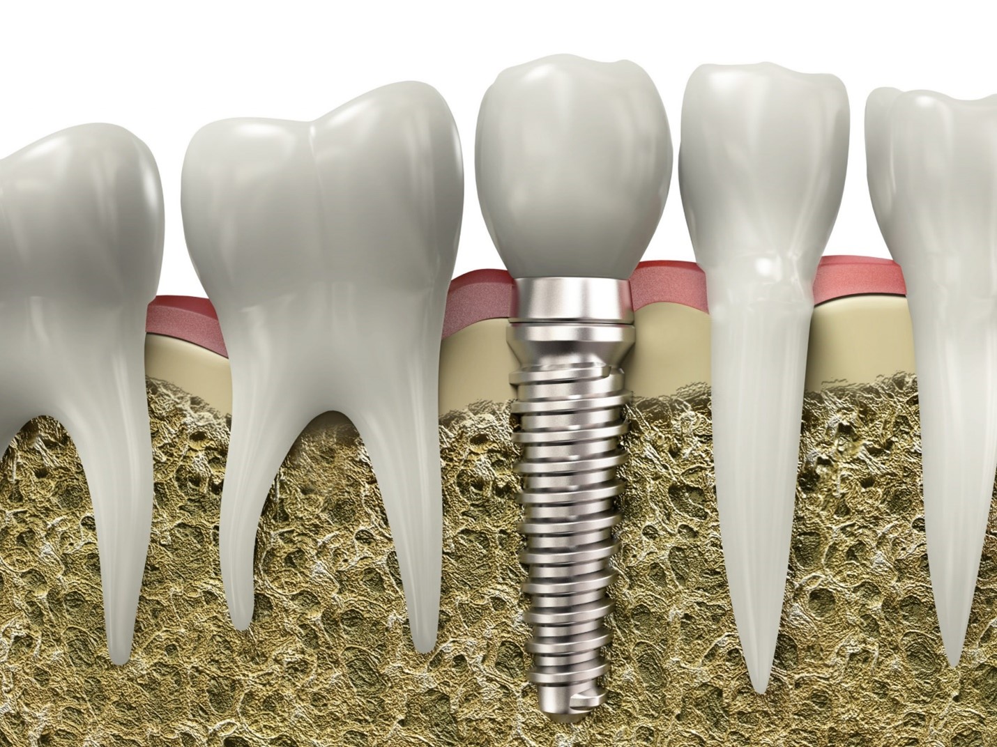 Benefits of cheap and installment implants