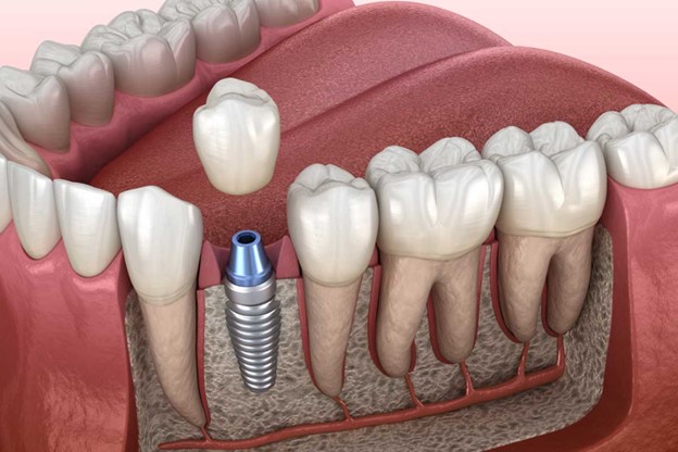 Cheap and installment dental implants in Islamabad