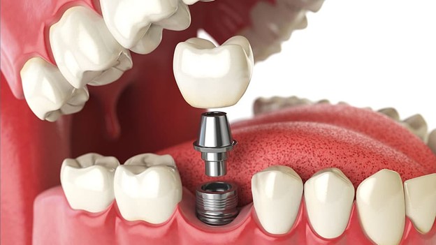 Cheap and installment dental implants in Islamabad