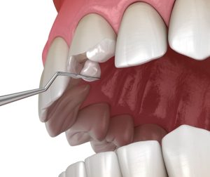 Dental Composite in Islamabad West