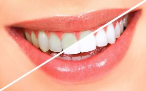 Teeth Bleaching in Islamabad West