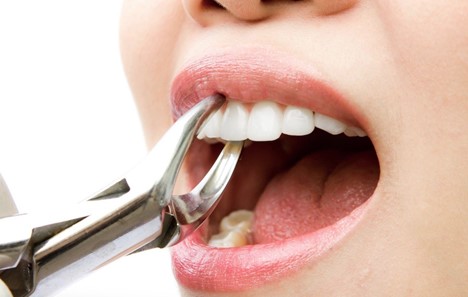 Tooth extraction in Islamabad West