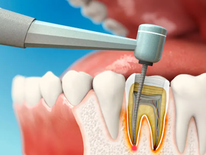 متخصص جراحی ریشه در کرمانشاه