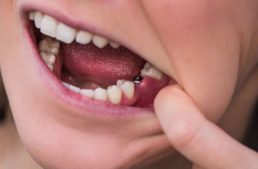 ایمپلنت در هرسین