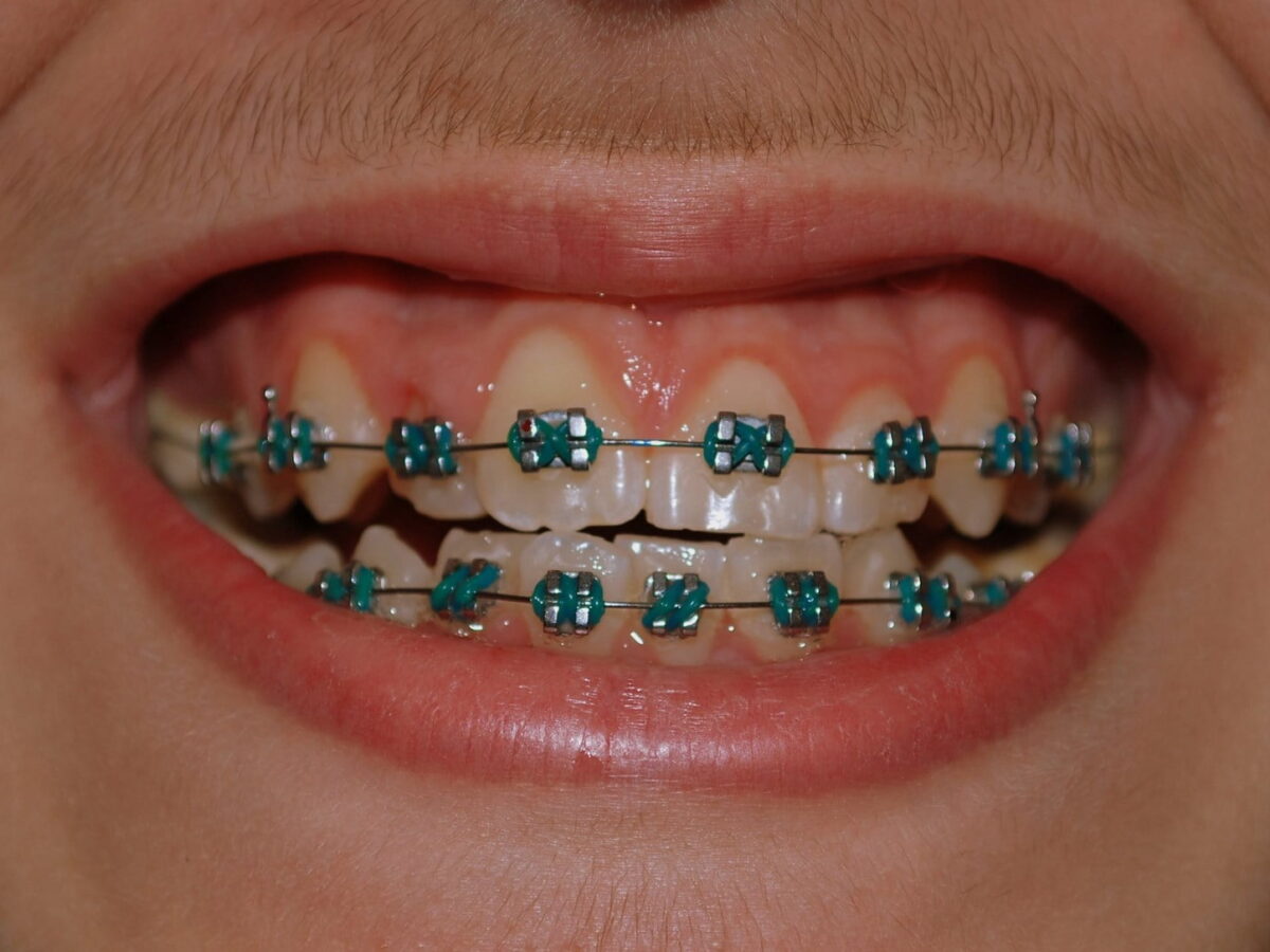 ارتودنسی یکروزه در هرسین