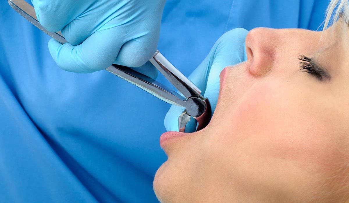 مراقبت‌های پس از کشیدن دندان در هرسین