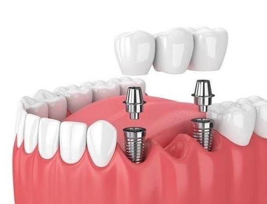 ایمپلنت در کرمانشاه