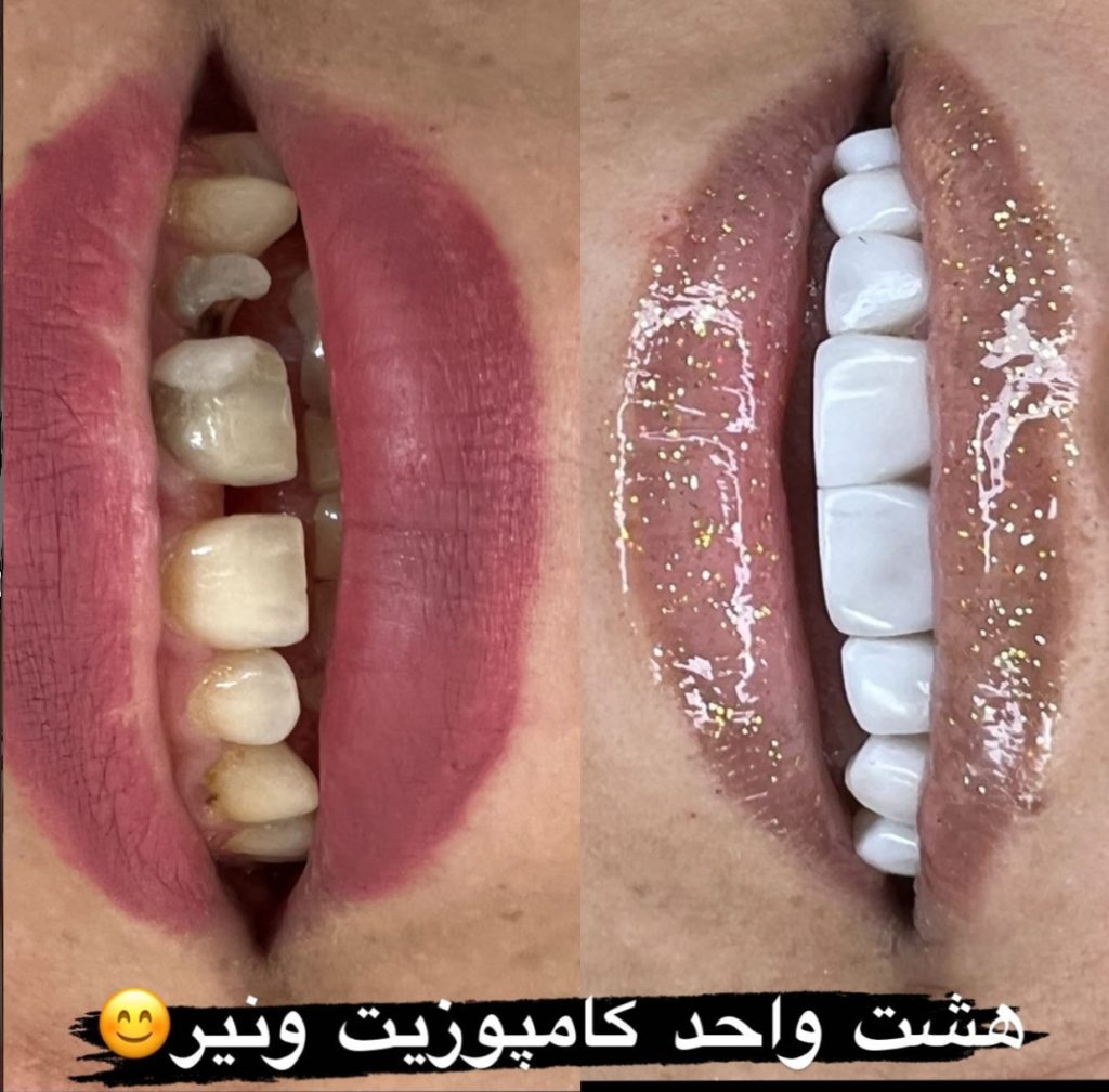 نمونه کار دندانپزشکی کامپوزیت در کرمانشاه