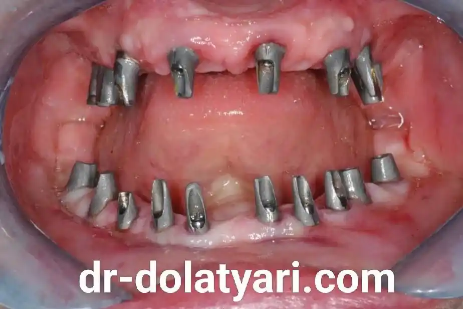 ایمپلنت در کرمانشاه