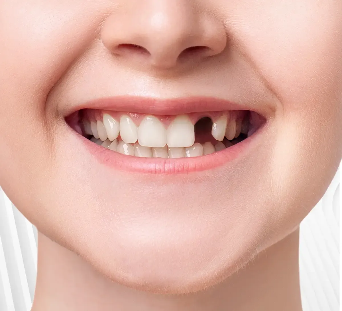 ایمپلنت در جوانرود، کاشت دندان در جوانرود