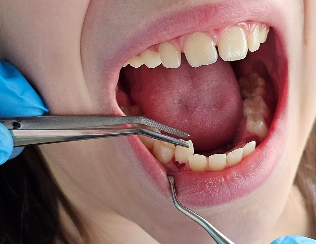 آیا جایگزینی برای کشیدن دندان وجود دارد