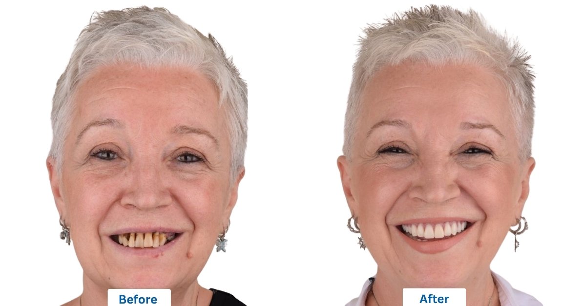 ایمپلنت اقساطی و ارزان در سقز