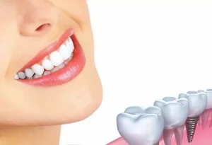 ایمپلنت دیجیتال در سقز؛ تکنولوژی مدرن برای لبخندی ماندگار