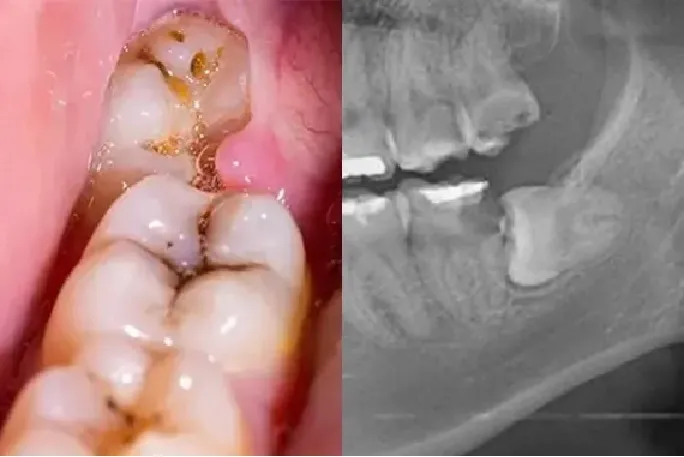 جراحی دندان عقل نهفته و نیمه نهفته در سقز