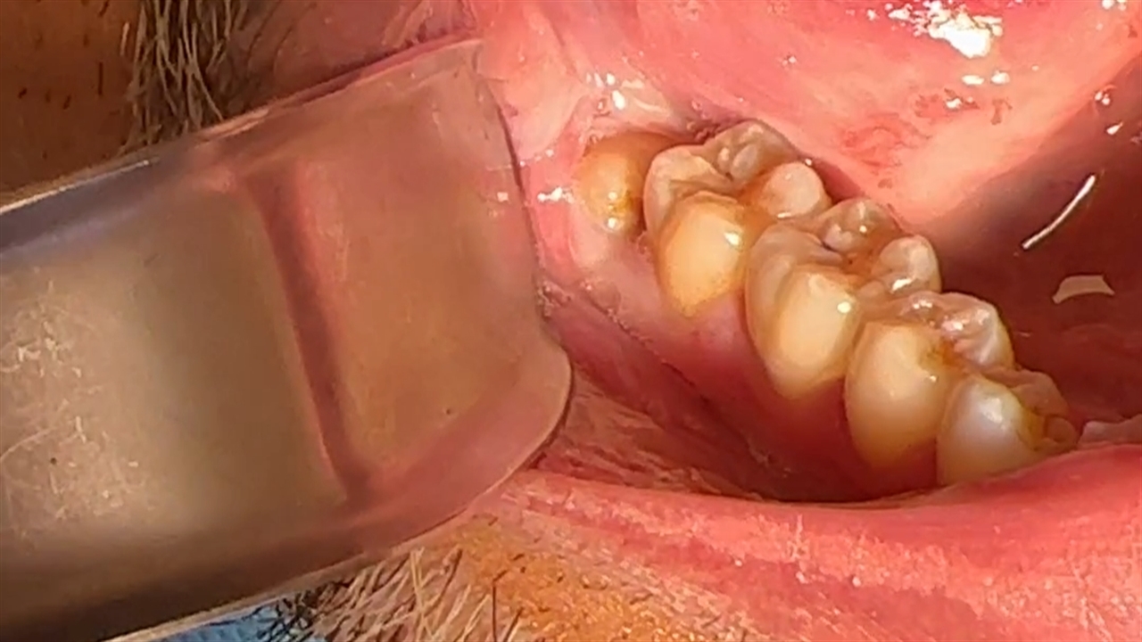 مراقبت‌های بعد از جراحی دندان عقل در جوانرود