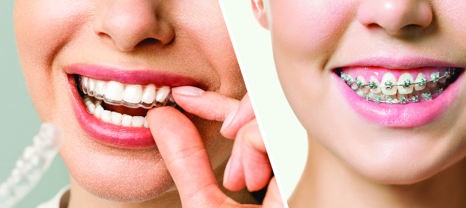 معایب و محدودیت‌های ارتودنسی شفاف در سقز