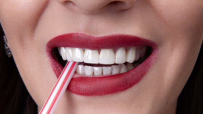 مقایسه کامپوزیت دندان با لمینت و روکش