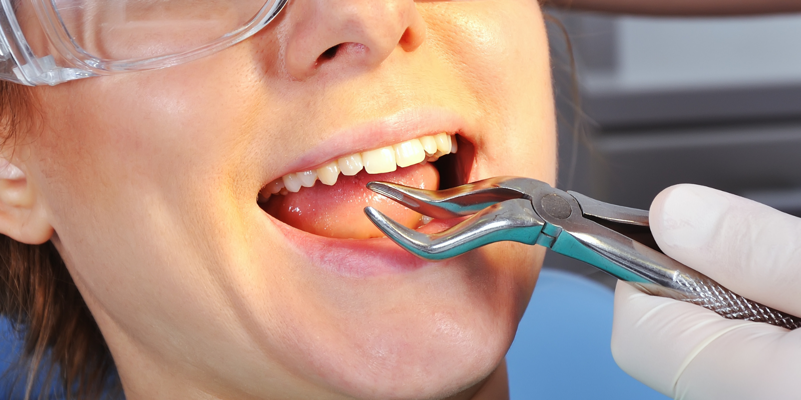 هزینه کشیدن دندان در جوانرود چقدر است