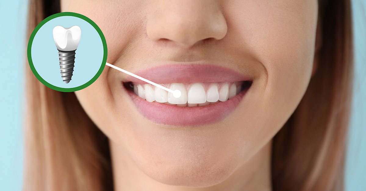چگونه ایمپلنت دندان ارزان را بدون افت کیفیت پیدا کنیم