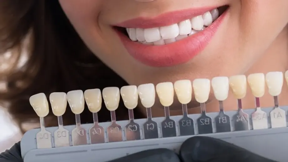 مزایای کامپوزیت دندان