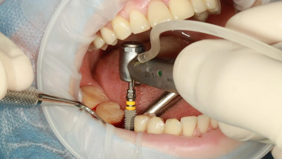 مواد مورد استفاده در ایمپلنت