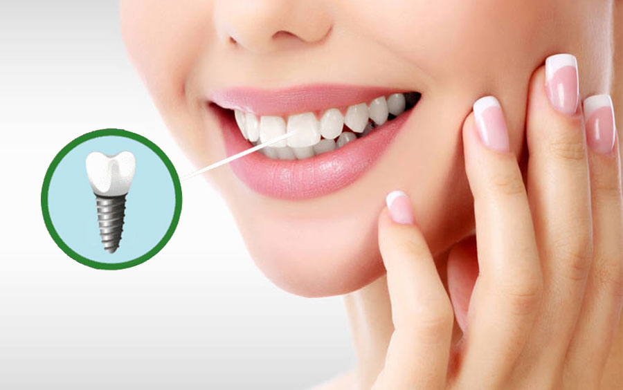 چرا ایمپلنت دندان بهترین گزینه است