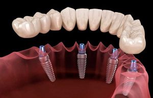 ایمپلنت فوری در گیلانغرب؛