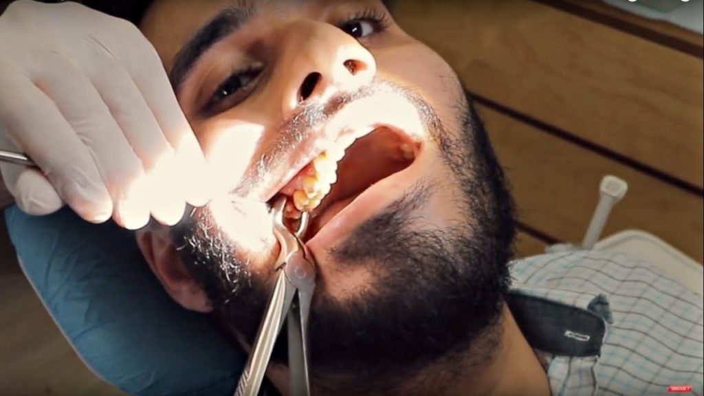 جراحی دندان عقل عقل نهفته و نیمه نهفته در گیلانغرب