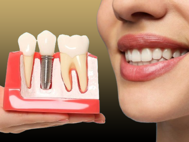 جنس و کیفیت ایمپلنت‌ها