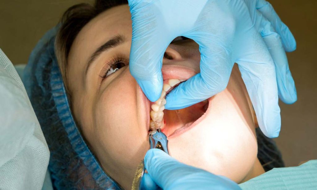 دندان عقل نهفته و نیمه نهفته دقیقاً چیست