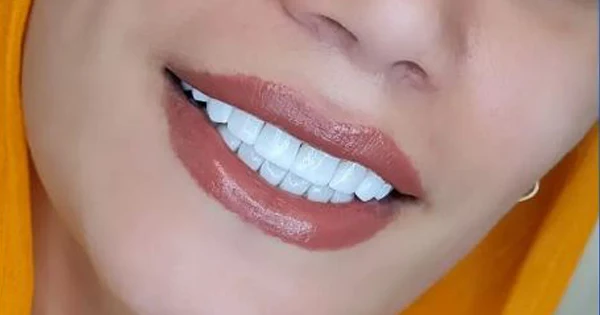 مراحل کامپوزیت دندان از مشاوره تا لبخند نهایی