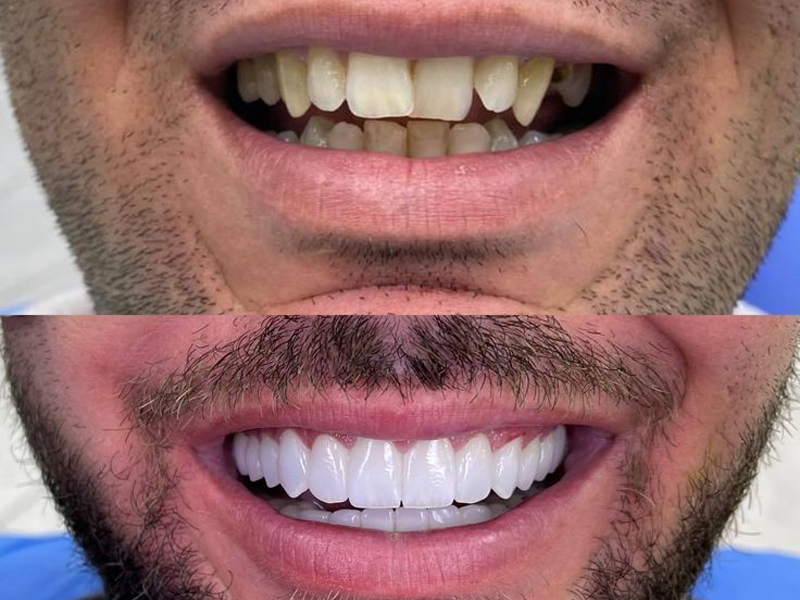 چرا مردم گیلانغرب به سمت کامپوزیت آمده‌اند