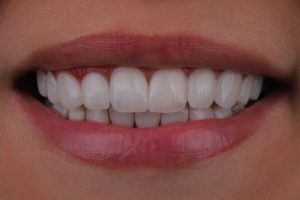 کامپوزیت دندان در گیلانغرب