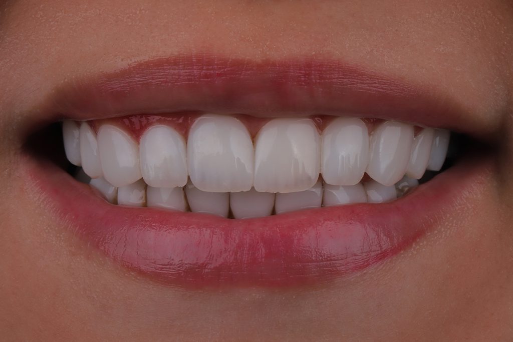 کامپوزیت دندان در گیلانغرب