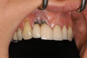 Symptoms of implant failure